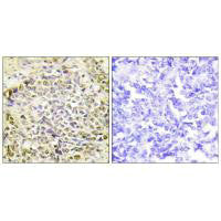 Immunohistochemistry analysis of paraffin-embedded human lung carcinoma tissue using IRX2 antibody.
