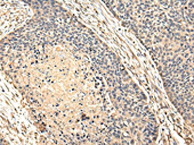 The image on the left is immunohistochemistry of paraffin-embedded Human esophagus cancer tissue using VPS28 Antibody(VPS28 Antibody) at dilution 1/20, on the right is treated with fusion protein. (Original magnification: ×200)Rabbit anti-Human VPS28 Polyclonal Antibody