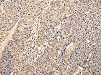 The image on the left is immunohistochemistry of paraffin-embedded Human breast cancer tissue using the antibody Antibody) at dilution 1/20, on the right is treated with fusion protein. (Original magnification: ×200)Rabbit anti-Human VPS28 Polyclonal Antibody