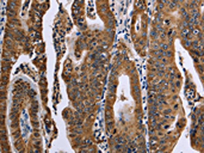 The image on the left is immunohistochemistry of paraffin-embedded Human gastric cancer tissue using FAF1 Antibody(FAF1 Antibody) at dilution 1/50, on the right is treated with synthetic peptide. (Original magnification: ×200)Rabbit anti-Human FAF1 Polyclonal Antibody