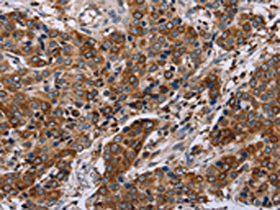 The image on the left is immunohistochemistry of paraffin-embedded Human liver cancer tissue using the antibody Antibody) at dilution 1/50, on the right is treated with synthetic peptide. (Original magnification: ×200)Rabbit anti-Human FAF1 Polyclonal Antibody