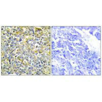 Immunohistochemistry analysis of paraffin-embedded human lung carcinoma tissue using TFIP8 antibody.Rabbit anti-Human TNFAIP8 Polyclonal Antibody