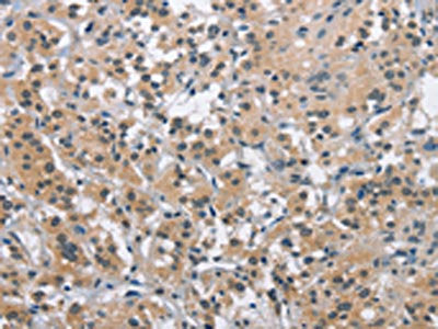 The image on the left is immunohistochemistry of paraffin-embedded Human thyroid cancer tissue using MAPT Antibody(MAPT Antibody) at dilution 1/25, on the right is treated with synthetic peptide. (Original magnification: ×200)