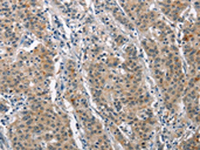 The image on the left is immunohistochemistry of paraffin-embedded Human gastic cancer tissue using the antibody Antibody) at dilution 1/25, on the right is treated with synthetic peptide. (Original magnification: ×200)