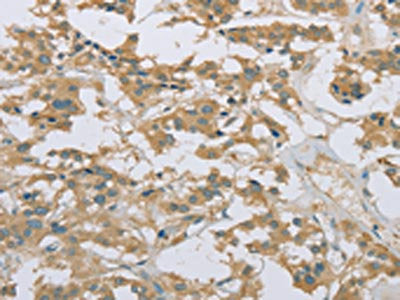 The image on the left is immunohistochemistry of paraffin-embedded Human thyroid cancer tissue using the antibody Antibody) at dilution 1/20, on the right is treated with fusion protein. (Original magnification: ×200)Rabbit anti-Human EEF2 Polyclonal Antibody