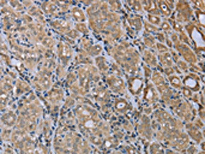 The image on the left is immunohistochemistry of paraffin-embedded Human thyroid cancer tissue using the antibody Antibody) at dilution 1/20, on the right is treated with fusion protein. (Original magnification: ×200)