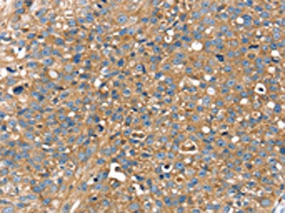 The image on the left is immunohistochemistry of paraffin-embedded Human breast cancer tissue using the antibody Antibody) at dilution 1/25, on the right is treated with fusion protein. (Original magnification: ×200)Rabbit anti-Human RAB9A Polyclonal Antibody