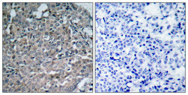 Immunohistochemical analysis of paraffin-embedded human breast carcinoma tissue using FAK(Ab-925) Antibody(left) or the same antibody preincubated with blocking peptide(right).Rabbit anti-Human PTK2 Polyclonal Antibody