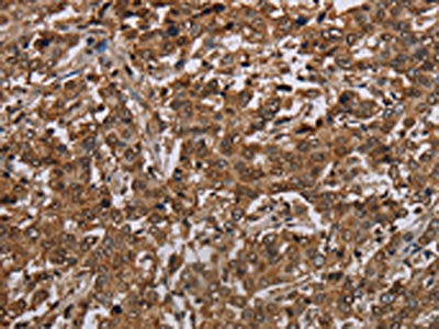 The image on the left is immunohistochemistry of paraffin-embedded Human liver cancer tissue using TBX5 Antibody(TBX5 Antibody) at dilution 1/35, on the right is treated with synthetic peptide. (Original magnification: ×200)Rabbit anti-Human TBX5 Polyclonal Antibody