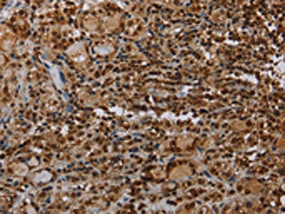 The image on the left is immunohistochemistry of paraffin-embedded Human thyroid cancer tissue using the antibody Antibody) at dilution 1/35, on the right is treated with synthetic peptide. (Original magnification: ×200)Rabbit anti-Human TBX5 Polyclonal Antibody