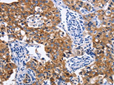 The image on the left is immunohistochemistry of paraffin-embedded Human lung cancer tissue using IFNG Antibody(IFNG Antibody) at dilution 1/30, on the right is treated with fusion protein. (Original magnification: X200)Rabbit anti-Human IFNG Polyclonal Antibody