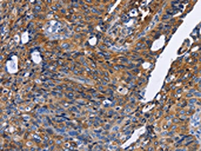 The image on the left is immunohistochemistry of paraffin-embedded Human cervical cancer tissue using the antibody Antibody) at dilution 1/30, on the right is treated with fusion protein. (Original magnification: X200)Rabbit anti-Human IFNG Polyclonal Antibody