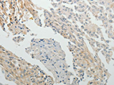 The image on the left is immunohistochemistry of paraffin-embedded Human cervical cancer tissue using SPATA17 Antibody(SPATA17 Antibody) at dilution 1/15, on the right is treated with fusion protein. (Original magnification: ×200)Rabbit anti-Human SPATA17 Polyclonal Antibody
