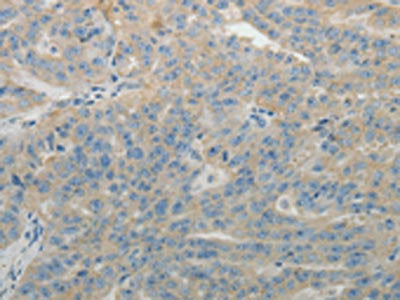 The image on the left is immunohistochemistry of paraffin-embedded Human ovarian cancer tissue using the antibody Antibody) at dilution 1/15, on the right is treated with fusion protein. (Original magnification: ×200)Rabbit anti-Human SPATA17 Polyclonal Antibody