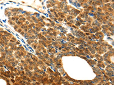 The image on the left is immunohistochemistry of paraffin-embedded Human thyroid cancer tissue using MYD88 Antibody(MYD88 Antibody) at dilution 1/20, on the right is treated with fusion protein. (Original magnification: ×200)Rabbit anti-Human MYD88 Polyclonal Antibody