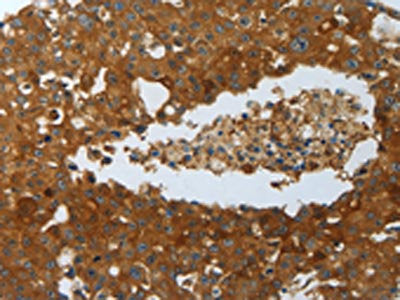 The image on the left is immunohistochemistry of paraffin-embedded Human breast cancer tissue using the antibody Antibody) at dilution 1/20, on the right is treated with fusion protein. (Original magnification: ×200)Rabbit anti-Human MYD88 Polyclonal Antibody