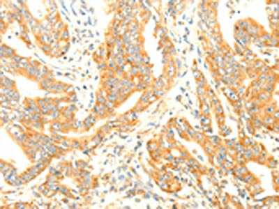 The image on the left is immunohistochemistry of paraffin-embedded Human gastric cancer tissue using TERF1 Antibody(TERF1 Antibody) at dilution 1/20, on the right is treated with fusion protein. (Original magnification: ×200)Rabbit anti-Human TERF1 Polyclonal Antibody