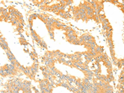 The image on the left is immunohistochemistry of paraffin-embedded Human colon cancer tissue using the antibody Antibody) at dilution 1/20, on the right is treated with fusion protein. (Original magnification: ×200)Rabbit anti-Human TERF1 Polyclonal Antibody