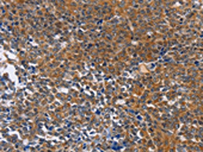 The image on the left is immunohistochemistry of paraffin-embedded Human ovarian cancer tissue using DPYSL4 Antibody(DPYSL4 Antibody) at dilution 1/15, on the right is treated with synthetic peptide. (Original magnification: ×200)Rabbit anti-Human DPYSL4 Polyclonal Antibody