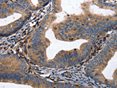 The image on the left is immunohistochemistry of paraffin-embedded Human cervical cancer tissue using the antibody Antibody) at dilution 1/15, on the right is treated with synthetic peptide. (Original magnification: ×200)Rabbit anti-Human DPYSL4 Polyclonal Antibody