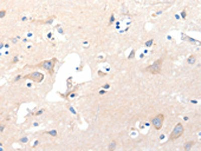 The image on the left is immunohistochemistry of paraffin-embedded Human brain tissue using GRM8 Antibody(GRM8 Antibody) at dilution 1/120, on the right is treated with synthetic peptide. (Original magnification: ×200)Rabbit anti-Human GRM8 Polyclonal Antibody