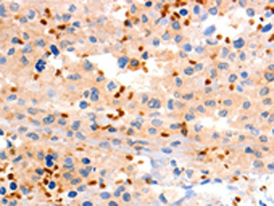 The image on the left is immunohistochemistry of paraffin-embedded Human ovarian cancer tissue using the antibody Antibody) at dilution 1/120, on the right is treated with synthetic peptide. (Original magnification: ×200)Rabbit anti-Human GRM8 Polyclonal Antibody