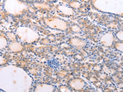 The image on the left is immunohistochemistry of paraffin-embedded Human thyroid cancer tissue using FBXO32 Antibody(FBXO32 Antibody) at dilution 1/25, on the right is treated with fusion protein. (Original magnification: ×200)Rabbit anti-Human FBXO32 Polyclonal Antibody