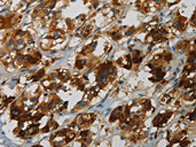 The image on the left is immunohistochemistry of paraffin-embedded Human colon cancer tissue using the antibody Antibody) at dilution 1/25, on the right is treated with fusion protein. (Original magnification: ×200)Rabbit anti-Human FBXO32 Polyclonal Antibody
