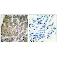 Immunohistochemical analysis of paraffin-embedded human breast carcinoma tissue using Cox2 antibody.Rabbit anti-Human PTGS2 Polyclonal Antibody