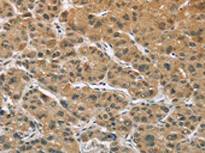 The image on the left is immunohistochemistry of paraffin-embedded Human liver cancer tissue using ELAC2 Antibody(ELAC2 Antibody) at dilution 1/30, on the right is treated with fusion protein. (Original magnification: ×200)Rabbit anti-Human ELAC2 Polyclonal Antibody