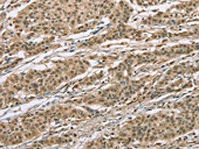 The image on the left is immunohistochemistry of paraffin-embedded Human gastic cancer tissue using the antibody Antibody) at dilution 1/30, on the right is treated with fusion protein. (Original magnification: ×200)Rabbit anti-Human ELAC2 Polyclonal Antibody