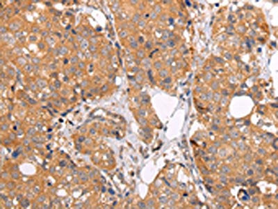 The image on the left is immunohistochemistry of paraffin-embedded Human breast cancer tissue using ABCC1 Antibody(ABCC1 Antibody) at dilution 1/25, on the right is treated with synthetic peptide. (Original magnification: X200)