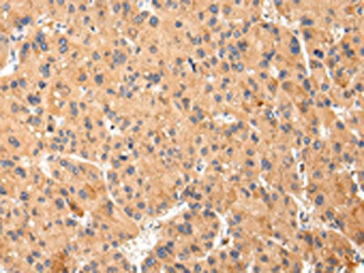 The image on the left is immunohistochemistry of paraffin-embedded Human liver cancer tissue using the antibody Antibody) at dilution 1/25, on the right is treated with synthetic peptide. (Original magnification: X200)