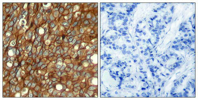 Immunohistochemical analysis of paraffin-embedded human breast carcinoma tissue using HER2 (Phospho-Tyr1248) Antibody (left) or the same antibody preincubated with blocking peptide (right).Rabbit anti-Human ERBB2 Polyclonal Antibody