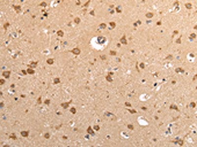 The image on the left is immunohistochemistry of paraffin-embedded Human brain tissue using VAMP4 Antibody(VAMP4 Antibody) at dilution 1/35, on the right is treated with fusion protein. (Original magnification: ×200)Rabbit anti-Human VAMP4 Polyclonal Antibody