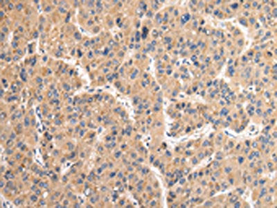 The image on the left is immunohistochemistry of paraffin-embedded Human liver cancer tissue using the antibody Antibody) at dilution 1/35, on the right is treated with fusion protein. (Original magnification: ×200)Rabbit anti-Human VAMP4 Polyclonal Antibody
