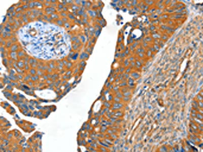 The image on the left is immunohistochemistry of paraffin-embedded Human cervical cancer tissue using the antibody Antibody) at dilution 1/40, on the right is treated with fusion protein. (Original magnification: ×200)