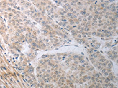 The image on the left is immunohistochemistry of paraffin-embedded Human liver cancer tissue using RBMS3 Antibody(RBMS3 Antibody) at dilution 1/70, on the right is treated with synthetic peptide. (Original magnification: ×200)Rabbit anti-Human RBMS3 Polyclonal Antibody