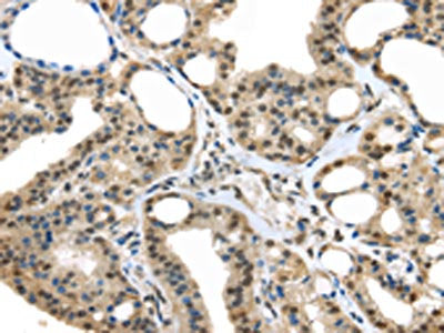 The image on the left is immunohistochemistry of paraffin-embedded Human thyroid cancer tissue using UCHL3 Antibody(UCHL3 Antibody) at dilution 1/25, on the right is treated with fusion protein. (Original magnification: ×200)Rabbit anti-Human UCHL3 Polyclonal Antibody