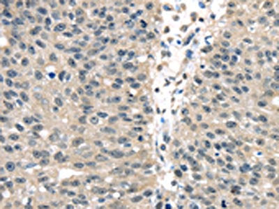 The image on the left is immunohistochemistry of paraffin-embedded Human breast cancer tissue using the antibody Antibody) at dilution 1/25, on the right is treated with fusion protein. (Original magnification: ×200)Rabbit anti-Human UCHL3 Polyclonal Antibody