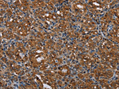 The image on the left is immunohistochemistry of paraffin-embedded Human thyroid cancer tissue using MCHR1 Antibody(MCHR1 Antibody) at dilution 1/25, on the right is treated with synthetic peptide. (Original magnification: ×200)