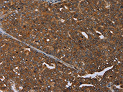 The image on the left is immunohistochemistry of paraffin-embedded Human ovarian cancer tissue using the antibody Antibody) at dilution 1/25, on the right is treated with synthetic peptide. (Original magnification: ×200)