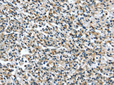 The image on the left is immunohistochemistry of paraffin-embedded Human prostate cancer tissue using ERP44 Antibody(ERP44 Antibody) at dilution 1/35, on the right is treated with fusion protein. (Original magnification: ×200)