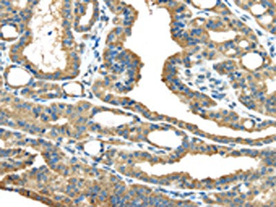 The image on the left is immunohistochemistry of paraffin-embedded Human thyroid  cancer tissue using the antibody Antibody) at dilution 1/35, on the right is treated with fusion protein. (Original magnification: ×200)