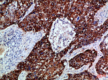 Immunohistochemical analysis of paraffin-embedded Human-lung-cancer, antibody was diluted at 1:100Rabbit anti-Human EPHB3 Polyclonal Antibody