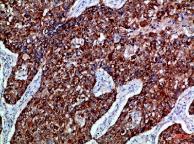 Immunohistochemical analysis of paraffin-embedded Human-lung-cancer, antibody was diluted at 1:100Rabbit anti-Human EPHB3 Polyclonal Antibody