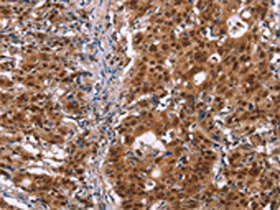 The image on the left is immunohistochemistry of paraffin-embedded Human gastic cancer tissue using the antibody Antibody) at dilution 1/40, on the right is treated with synthetic peptide. (Original magnification: ×200)