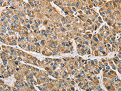 The image on the left is immunohistochemistry of paraffin-embedded Human liver cancer tissue using ARHGAP25 Antibody(ARHGAP25 Antibody) at dilution 1/40, on the right is treated with fusion protein. (Original magnification: ×200)Rabbit anti-Human ARHGAP25 Polyclonal Antibody