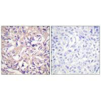 Immunohistochemistry analysis of paraffin-embedded human breast carcinoma tissue using TK (Ab-13) antibody.Rabbit anti-Human TK1 Polyclonal Antibody