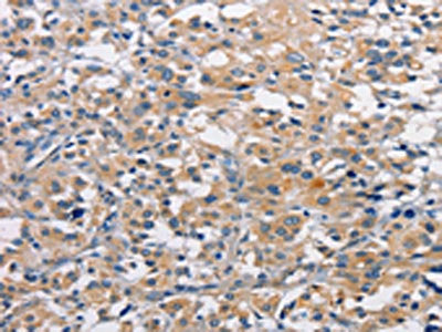 The image on the left is immunohistochemistry of paraffin-embedded Human thyroid cancer tissue using PRKCE Antibody(PRKCE Antibody) at dilution 1/50, on the right is treated with fusion protein. (Original magnification: ×200)Rabbit anti-Human PRKCE Polyclonal Antibody